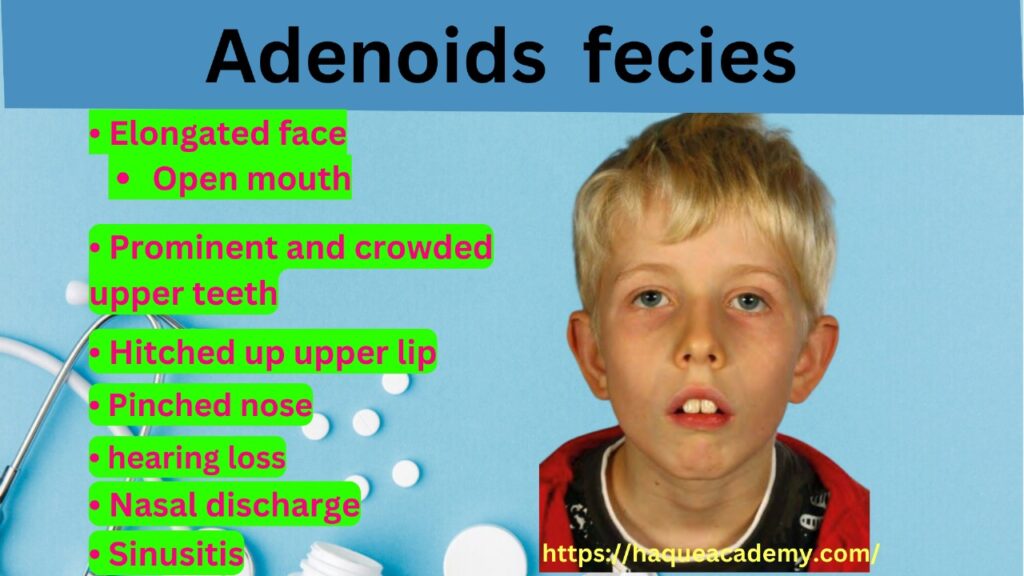 Adenoid facies