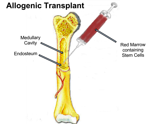 Blood cancer bone marrow transplant