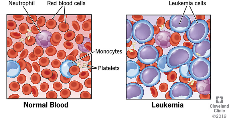 Blood cancer leukemia