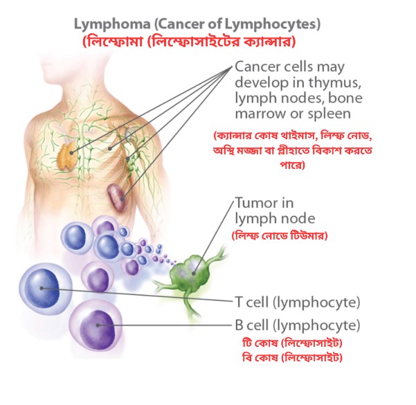 Lymphoma in Bangla