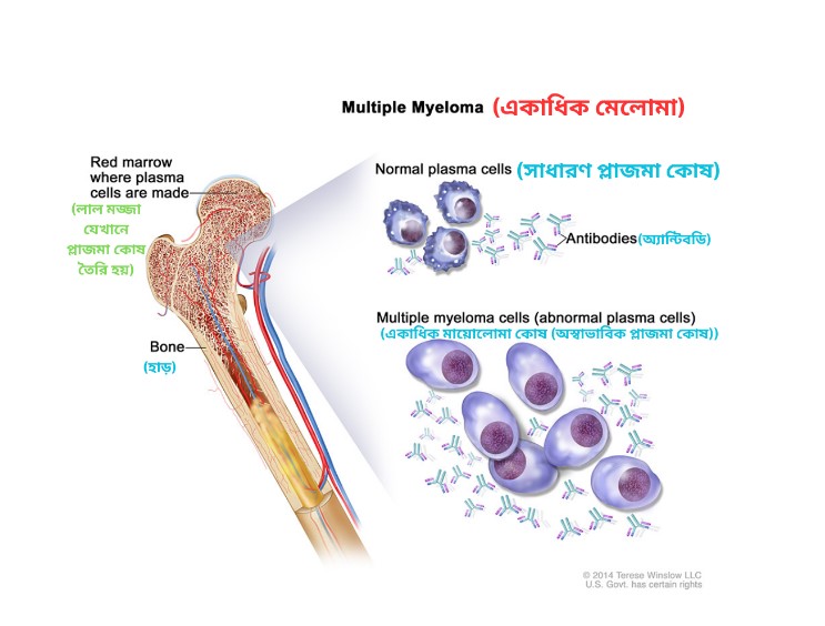 Multiple Myeloma in Bangla