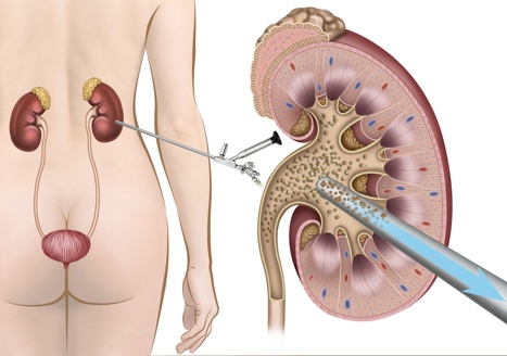 Percutaneous nephrolithotomy(PCNL)