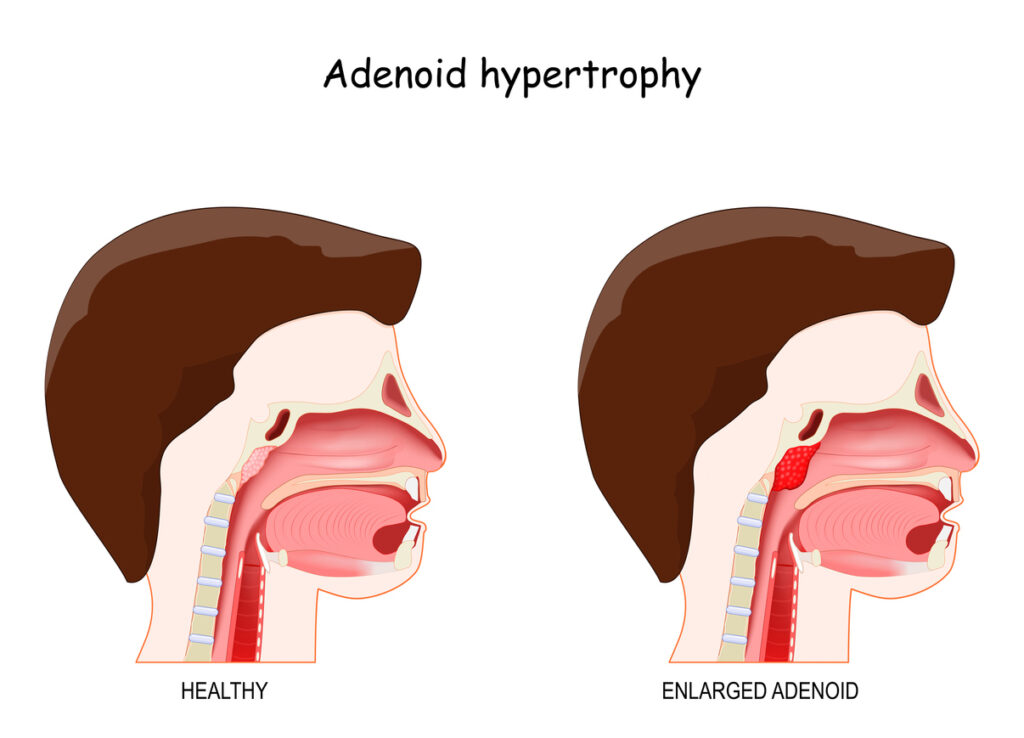 Adenoid hypertrophy