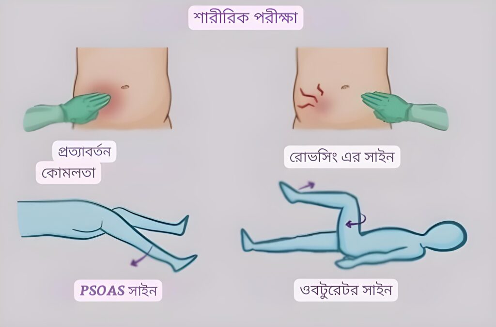 অ্যাপেন্ডিসাইটিস রোগ কিভাবে নির্ণয় করা যায়